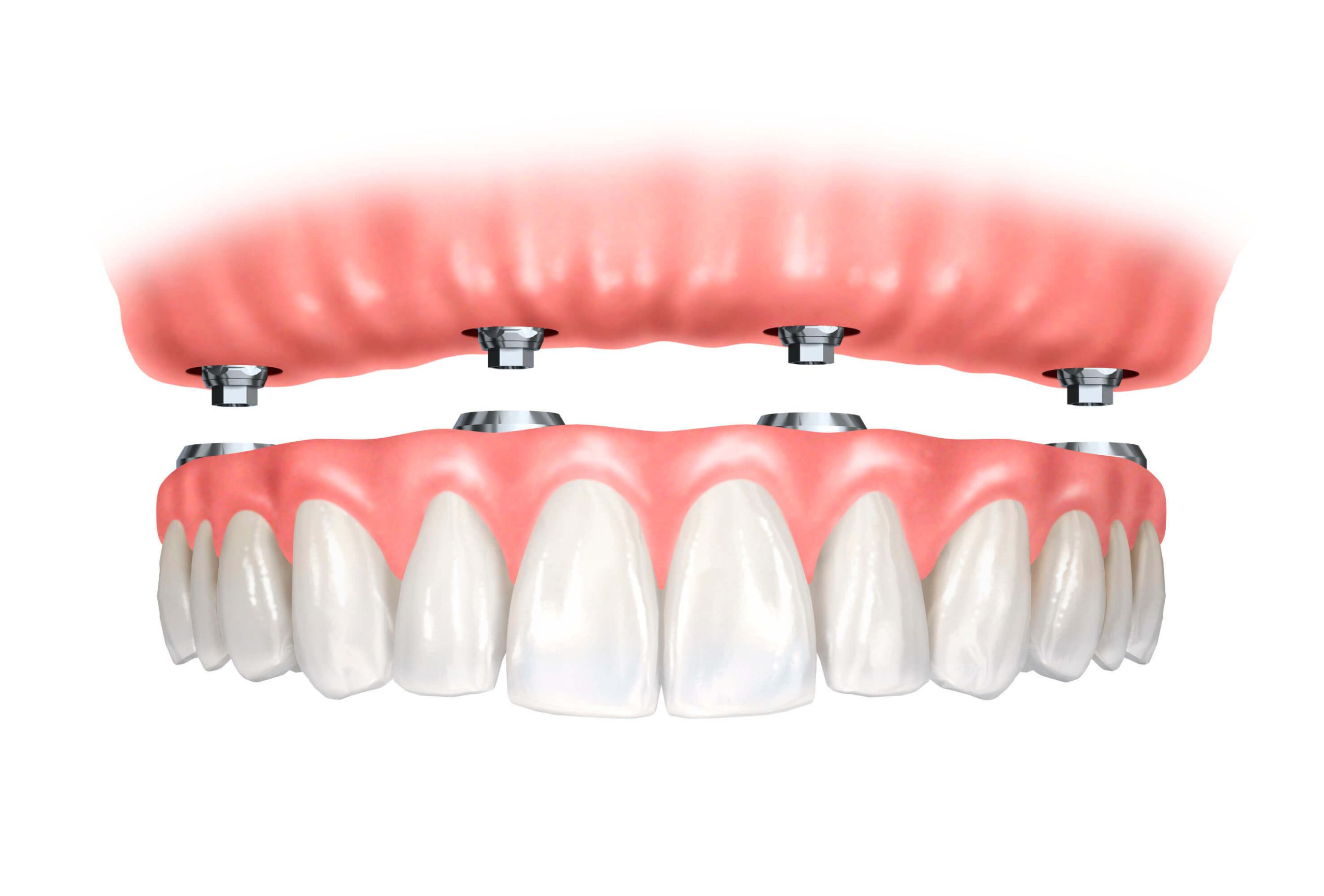 Implant-retained-denture