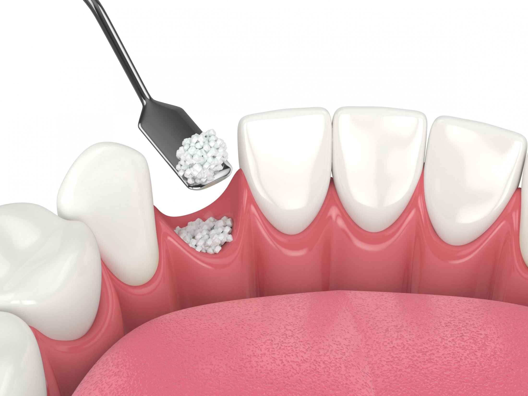 bone_grafting