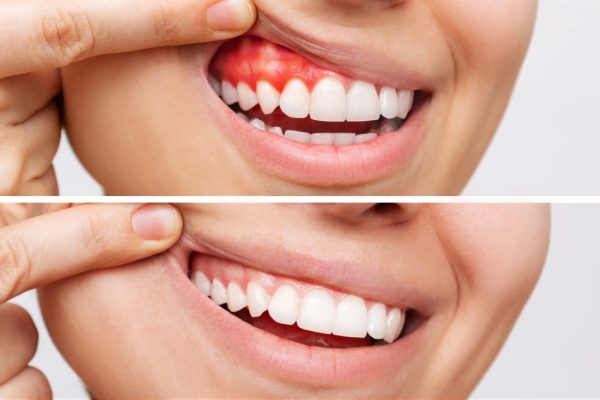 Gum Disease Treatment-600x400