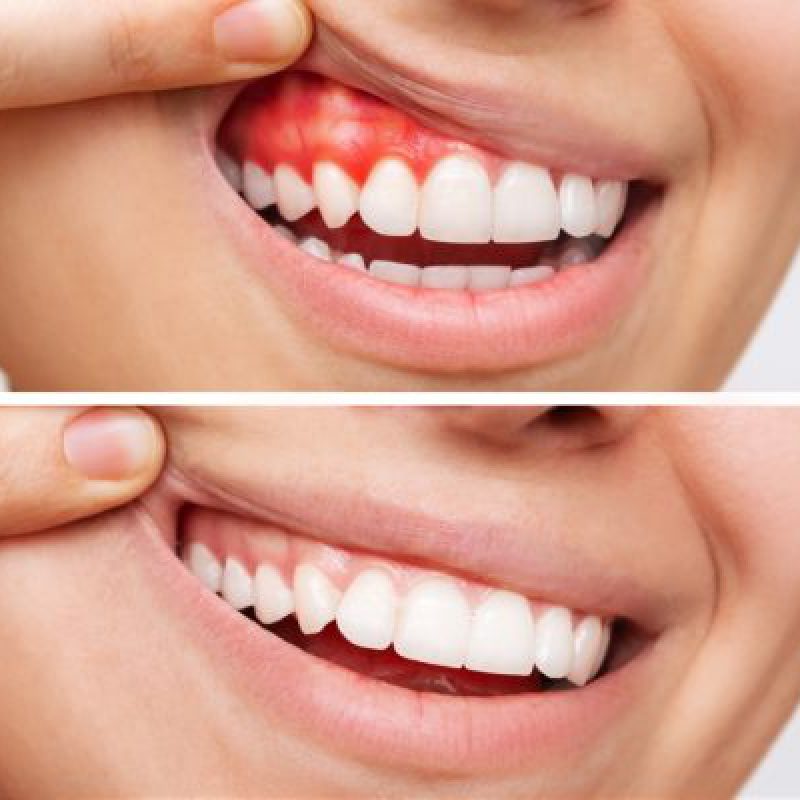 Gum Disease Treatment-600x400